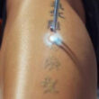 Tattoo Laser Entfernung